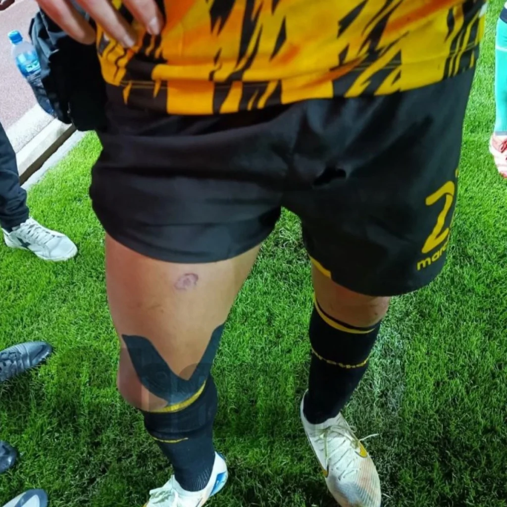 Juan Godoy cedera di paha usai terkena petasan.